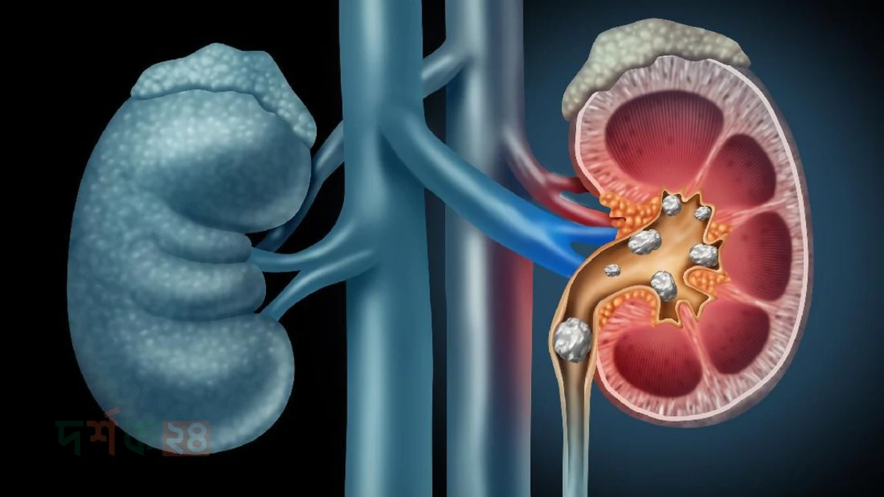 kidney-rog-er-lokkhan